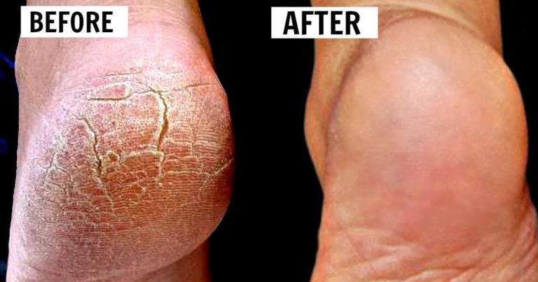 How To Heal Cracked Heels