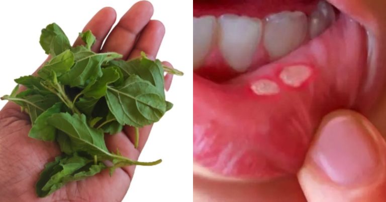 Home Remedy For Mouth Ulcer Problem