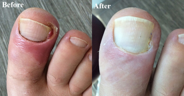 Home Remedy For Fungal Nail