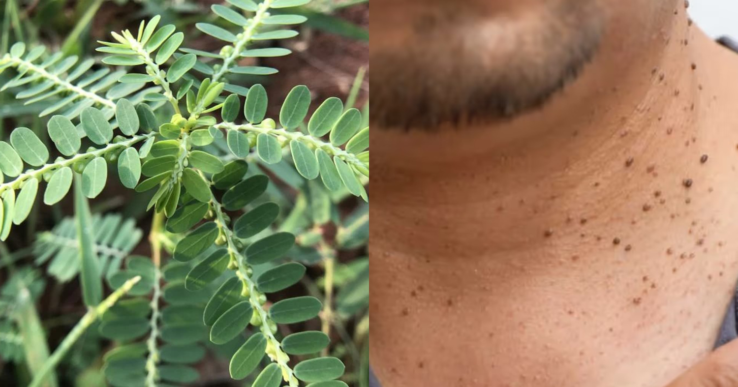 Home Remedy For Warts And Moles