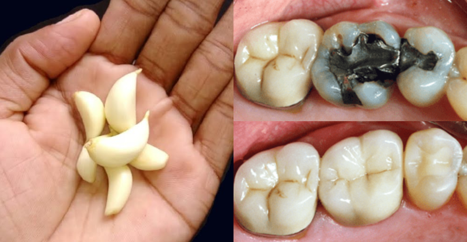 Natural Remedy For Toothache