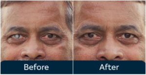 Cataract Treatment