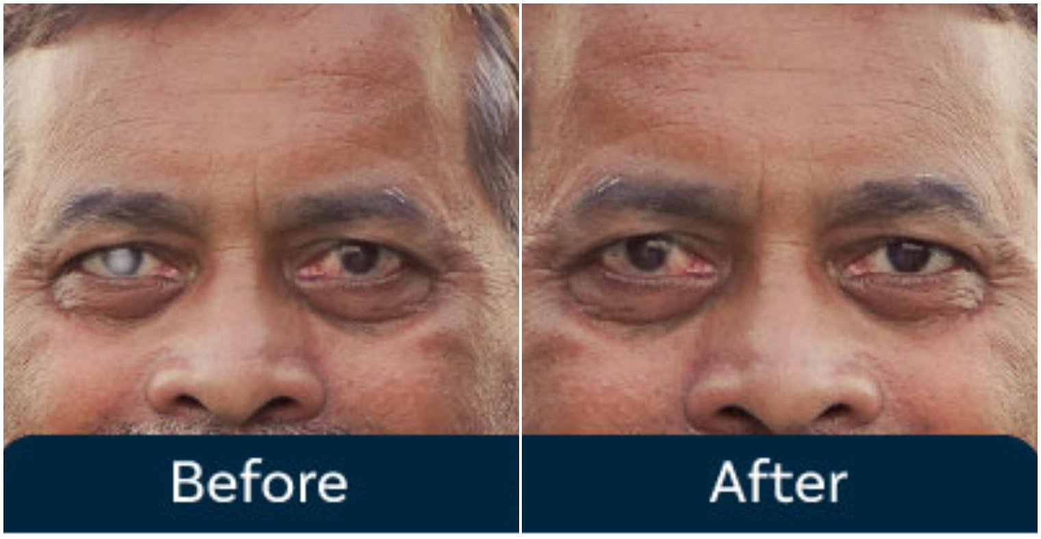 Cataract Treatment