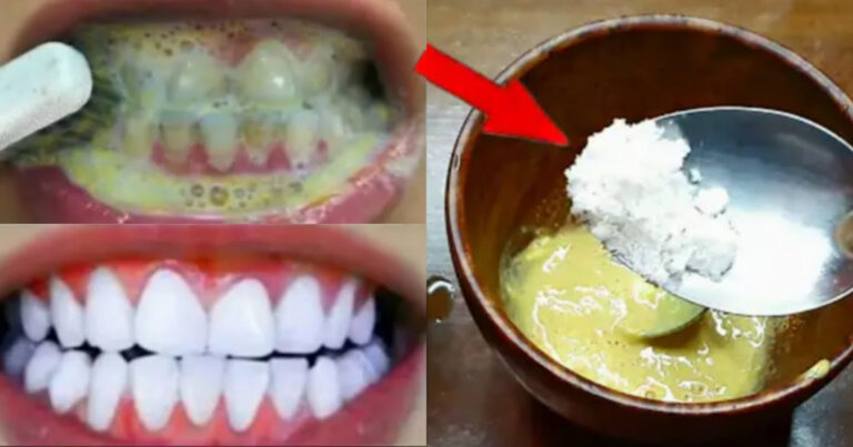 Teeth Whitening Treatment