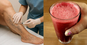 Varicose Veins Treatment